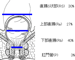 図2: 直腸がんの部位別発生頻度