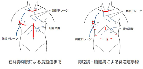 食道がんに対する根治手術の創部 図11.食道がんに対する根治手術の創部