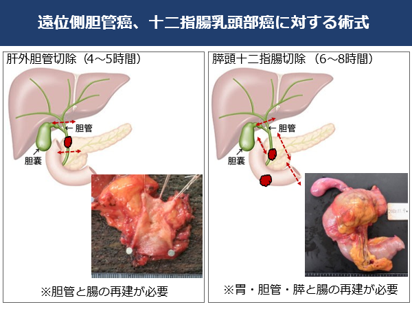 遠位側胆管がん