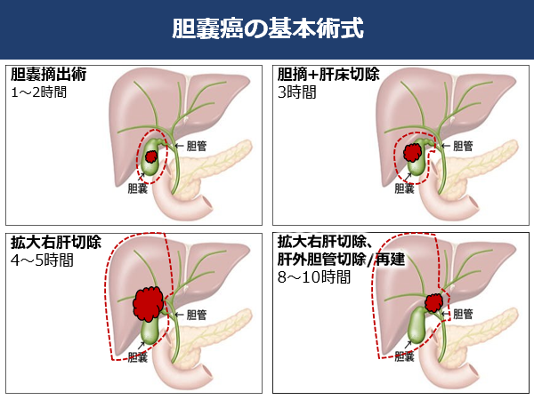 胆嚢がんの基本術式