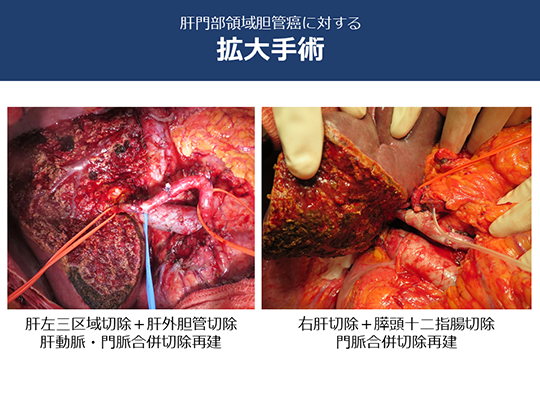 肝門部領域胆管癌に対する拡大手術