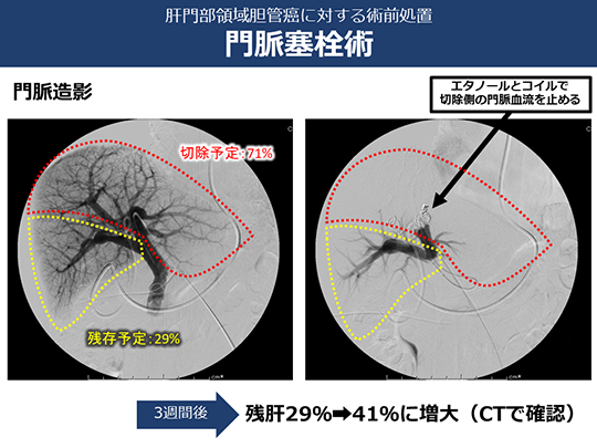 肝門部領域胆管がんに対する門脈塞栓術