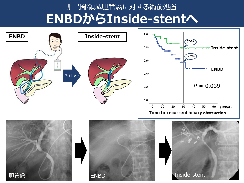 肝門部領域胆管がんにたいする術前処置