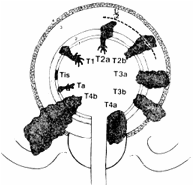 図3:膀胱がんの浸潤(深達)度分類