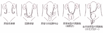 図4:尿路変向法いろいろ