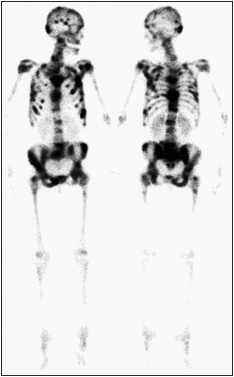 ãéª¨è»¢ç§»ãå¤çºæ§ãã®ç»åæ¤ç´¢çµæ