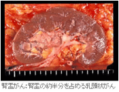 腎盂がん:腎盂の約半分を占める乳頭状がん