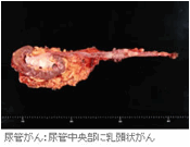尿管がん:尿管中央部に乳頭状がん