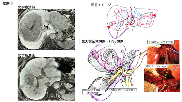 症例@ 69歳 男性