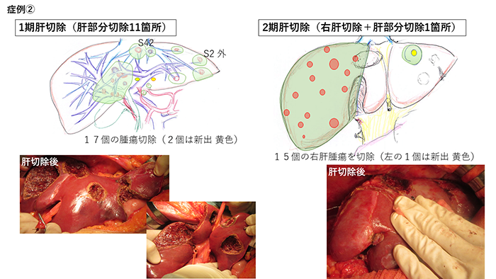 症例A 61歳 女性