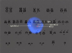 Fig.3: Follicular lymphoma: Cytogenetics and Fluorescence In Situ Hybridisation (FISH) for IgH/BCL2