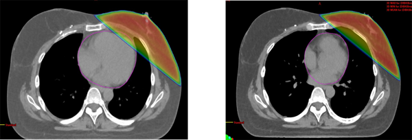 図1.　通常呼吸時（左）とDIBH（右）の心臓線量の比較（心臓：ピンクのライン）
