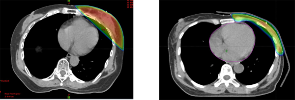 図2.　乳腺温存照射における3D-CRT（左）と乳房全切除術後照射におけるVMAT（右）の治療計画 