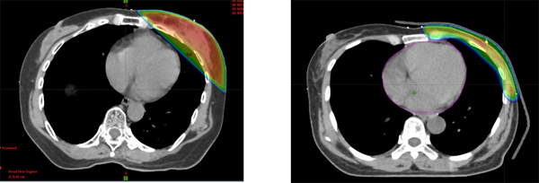 図2. 乳腺温存照射における3D-CRT(左)と乳房全切除術後照射におけるVMAT(右)の治療計画