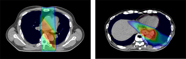図. 3D-CRT(左)とVMAT(右)の治療計画の比較
