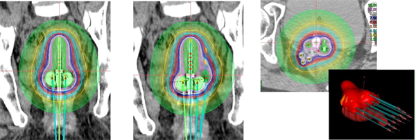 図1. 腔内照射における通常の腔内照射（左）、ハイブリッド照射（中央）、組織内照射（右）の治療計画