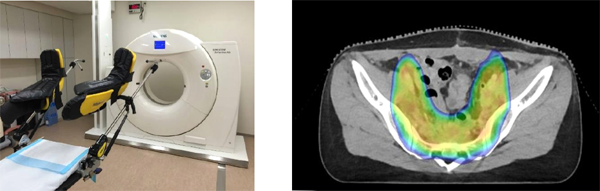 図2.　腔内照射治療室CT（左）と、子宮頸がん術後全骨盤VMATの治療計画（右）
