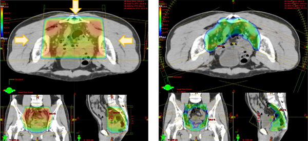 図2. 3D-CRT（左）とVMAT（右）の治療計画