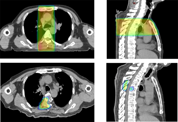 図1.　胸椎に対する前後対向2門照射（上）と、VMATによる再照射例（下）