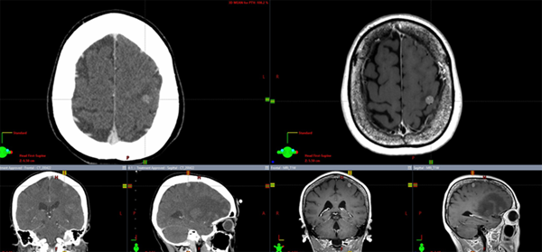 図1.　治療計画CT（左）とMRI（右）とのFusion