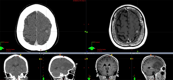 図1. 治療計画CT(左)とMRI(右)とのFusion
