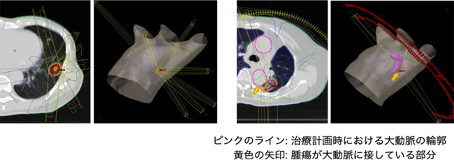 図. 3D-CRT（左）とVMAT（右）の治療計画