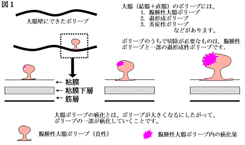 大腸がんの内視鏡治療と成績 大腸がん がん研有明病院