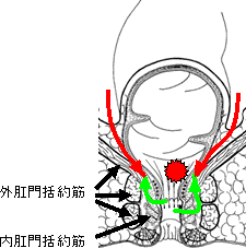 図1: 外肛門括約筋を温存し内肛門括約筋を部分的に切除する手術