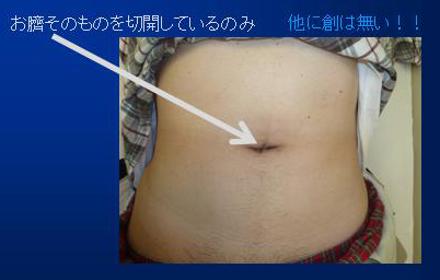図6: 単孔式腹腔鏡下手術後の創