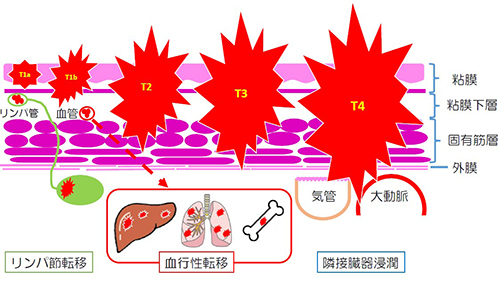 図3．食道癌の壁深達度と浸潤・転移様式