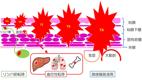 食道癌の壁深達度と浸潤・転移様式 図3.食道癌の壁深達度と浸潤・転移様式