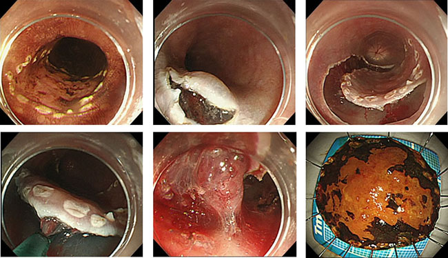 図9．食道がんに対する内視鏡的粘膜下層剥離術(ESD) 