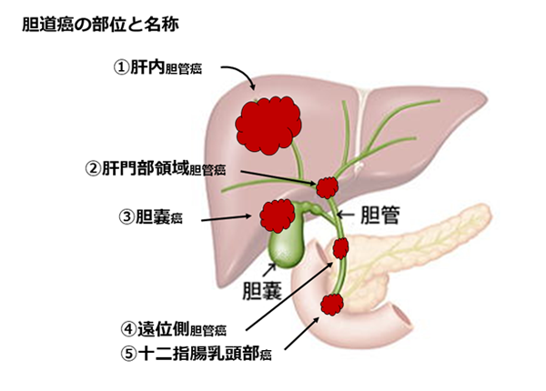 胆管 癌 余命