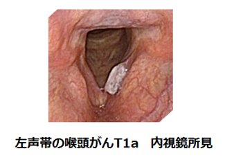 喉頭がん 頭頸部がん がん研有明病院