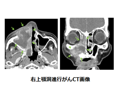 各手術について 耳鼻咽喉科 受診案内 聖路加国際病院