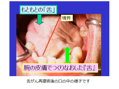 口腔がん 頭頸部がん がん研有明病院