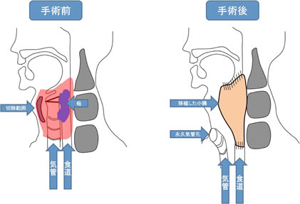 図：咽頭部の術前、術後