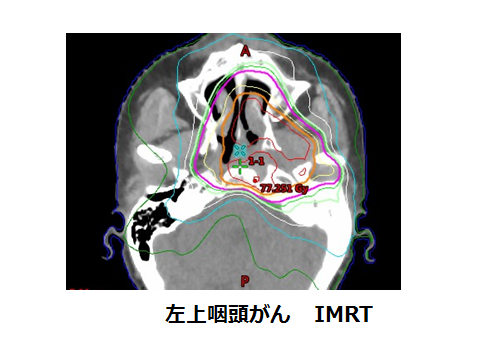 咽頭がん 頭頸部がん がん研有明病院