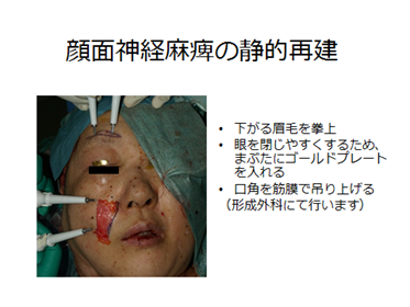 唾液腺がん 頭頸部がん がん研有明病院