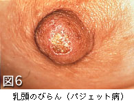図6　乳頭のびらん（パジェット病）