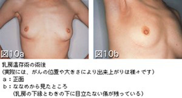 図9　右の乳房切除後