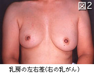 図2　乳房の左右差（右の乳がん）