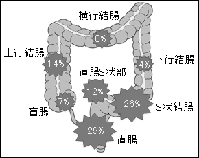 癌 s 状 結腸 S状結腸癌について！症状や原因、手術方法や生存率を知っておこう！