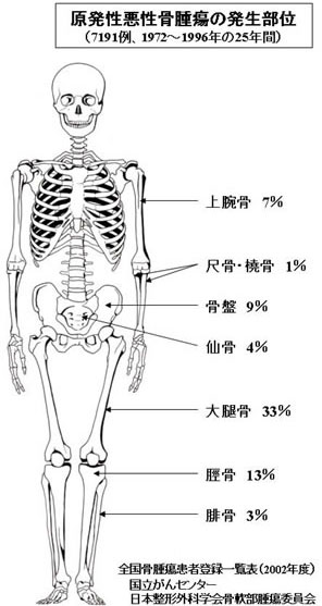 各骨軟部腫瘍 がんに関する情報 がん研有明病院