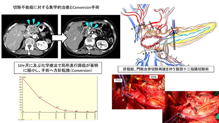 膵臓がんの進行タイムライン