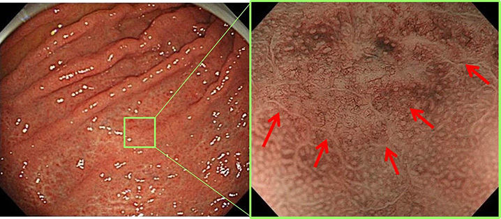 甲状腺未分化癌 橋本病 バセドウ病 甲状腺超音波エコー検査 甲状腺 専門医 長崎甲状腺クリニック大阪
