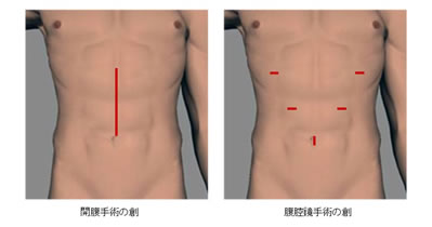 手術 腹筋 開腹 お腹の手術後、入浴/飲酒/仕事復帰はいつ？運転や性生活は？