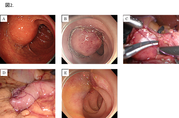腫瘍 十二指腸 胃十二指腸粘膜下腫瘍｜千葉大学大学院医学研究院 先端応用外科学