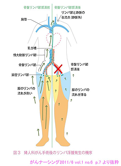 リンパ浮腫治療室とは リンパ浮腫治療室 がん研有明病院