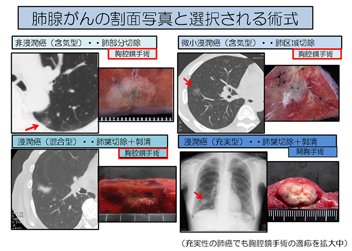 肺腺がんの割面写真と選択される術式